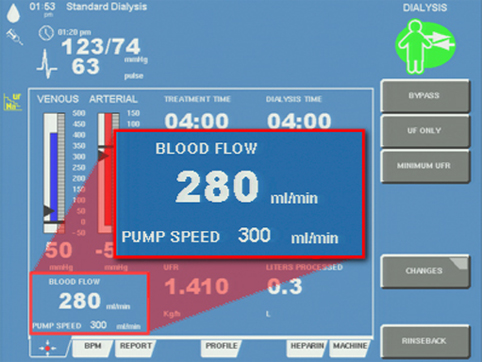 Diascan monitoring system interface showing a close up of blood flow and pump speed readings