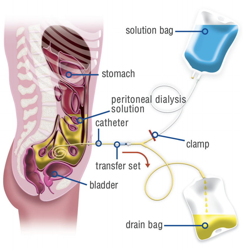 Infographic showing how Peritoneal Dialysis works
