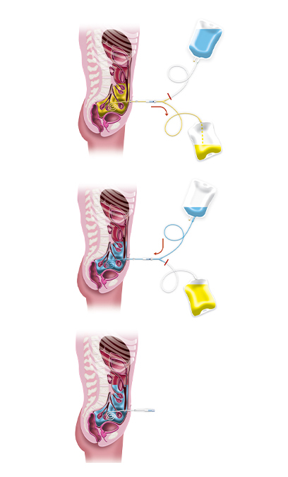 Diagram of a PD exchange: drain, fill, dwell